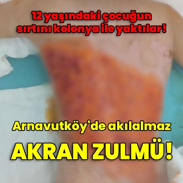 Akran zulmü! Çocuğun sırtını kolonya ile yaktılar